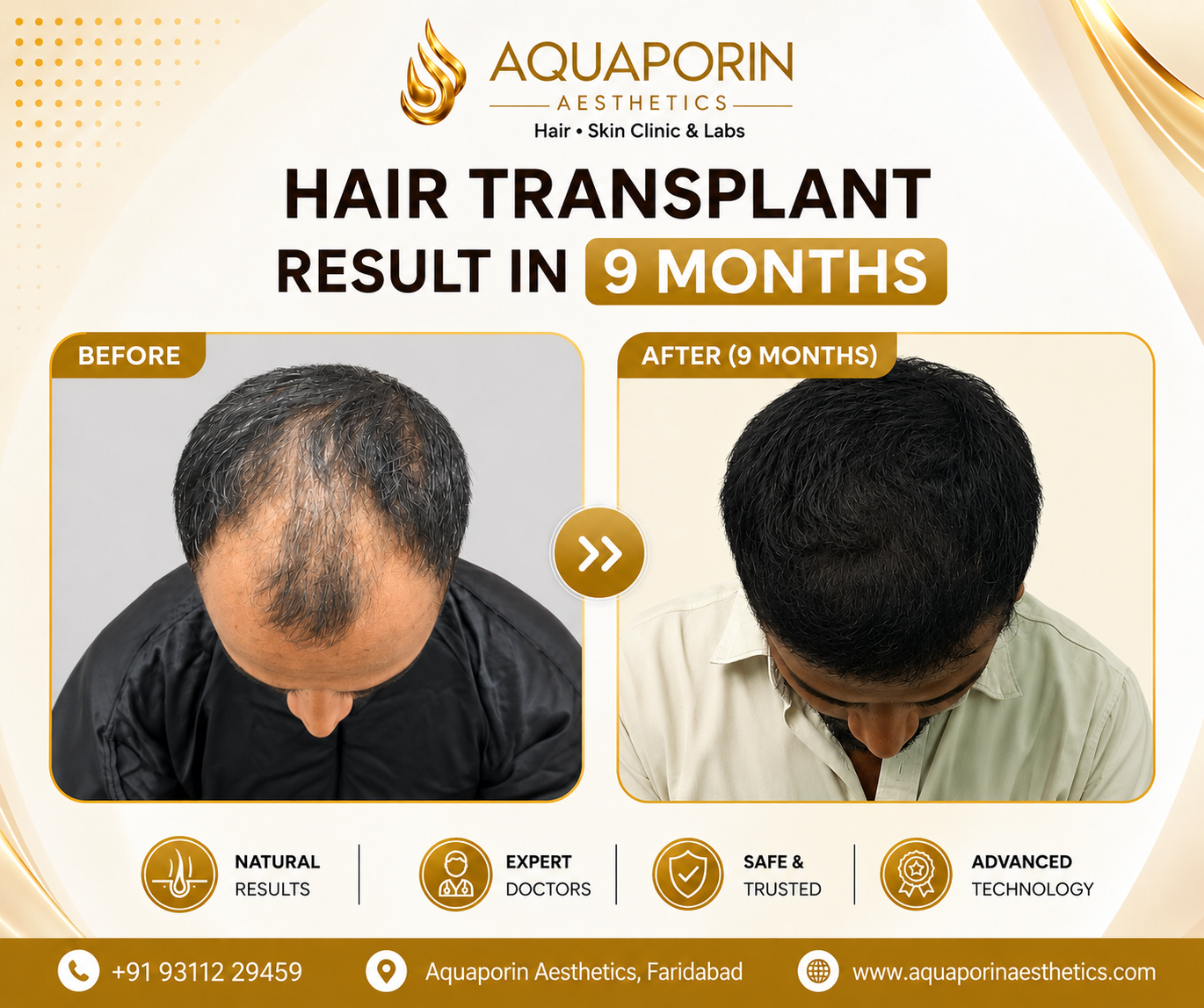 Hair Transplant