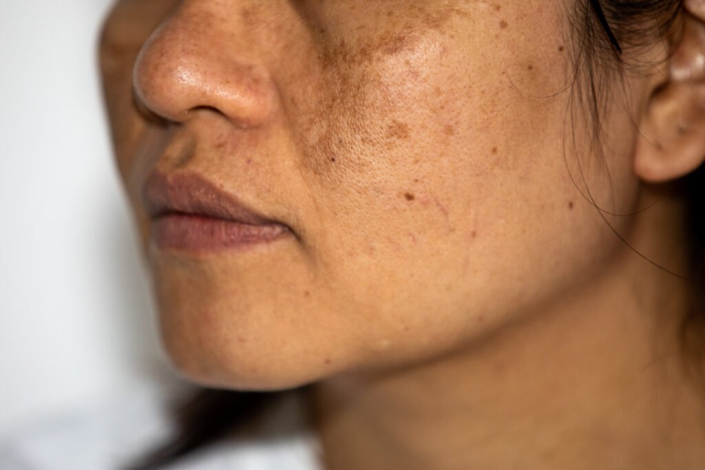 Pigmentation Treatment